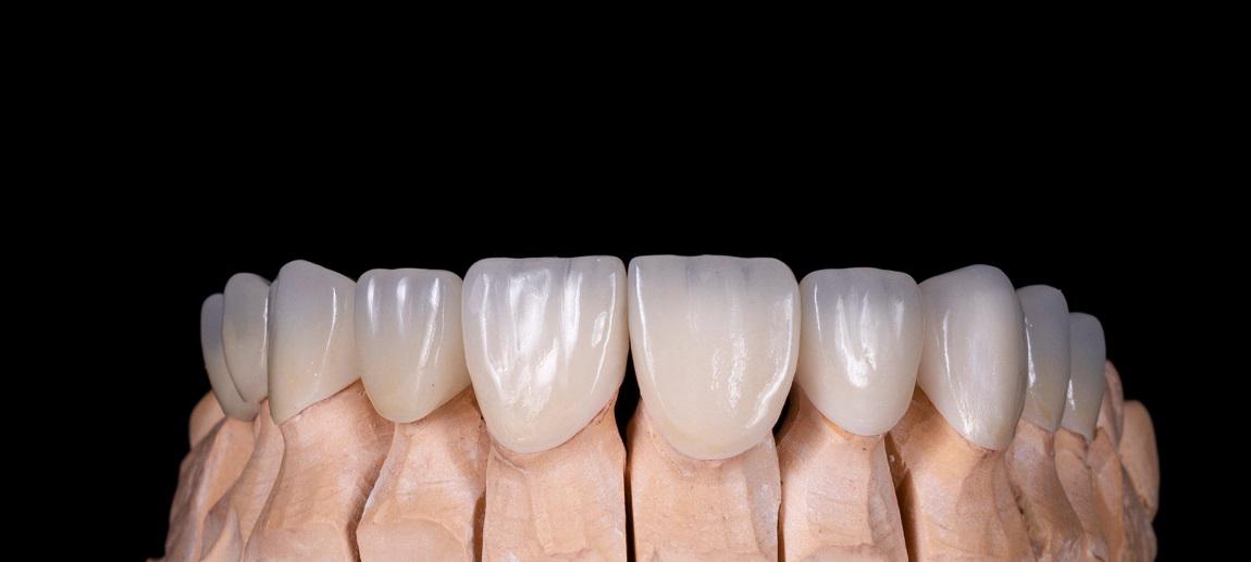 Revitalize Your Smile With Natural-Looking Dental Crowns