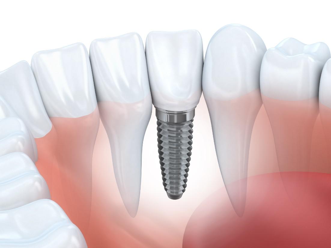 Dental Implants Wildomar, CA